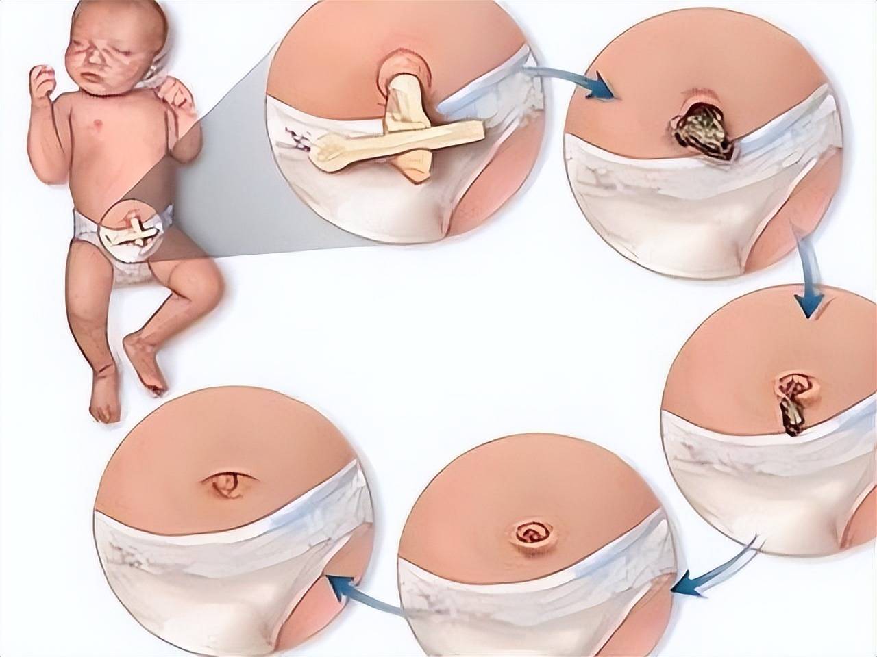 新生儿脐部护理的重要性(婴儿脐带怎么护理)