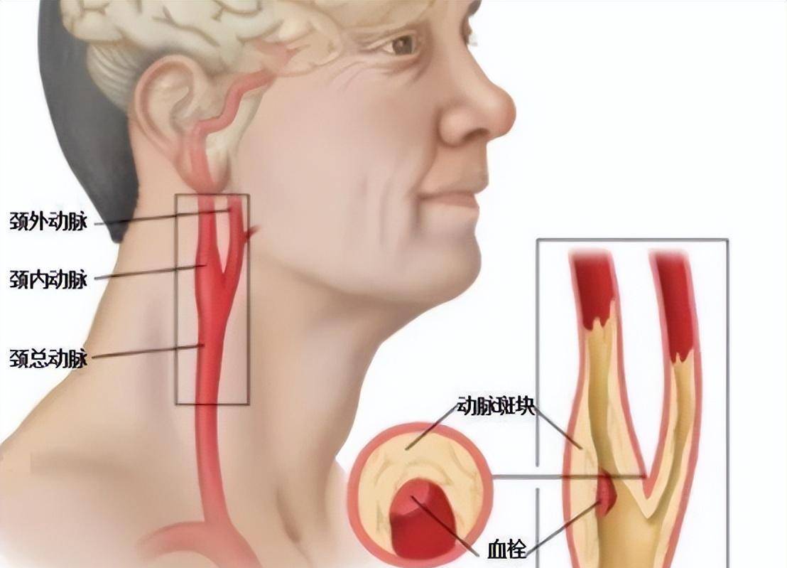 颈动脉做什么检查图片