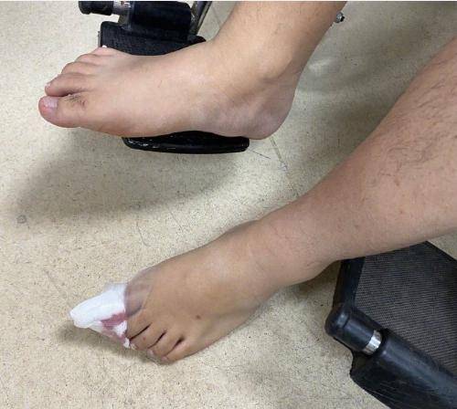 木木撸话:uzi脚受伤近期不能行走!