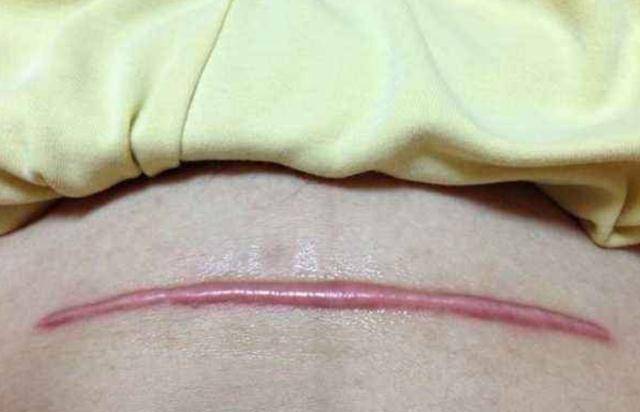 宁可"被侧切"也别撕裂,医生几句话说出其中道理,你选对了吗?