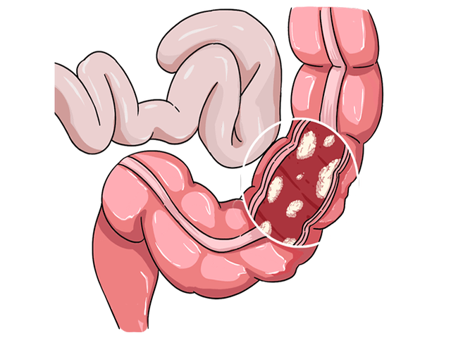 结肠癌图片卡通图片