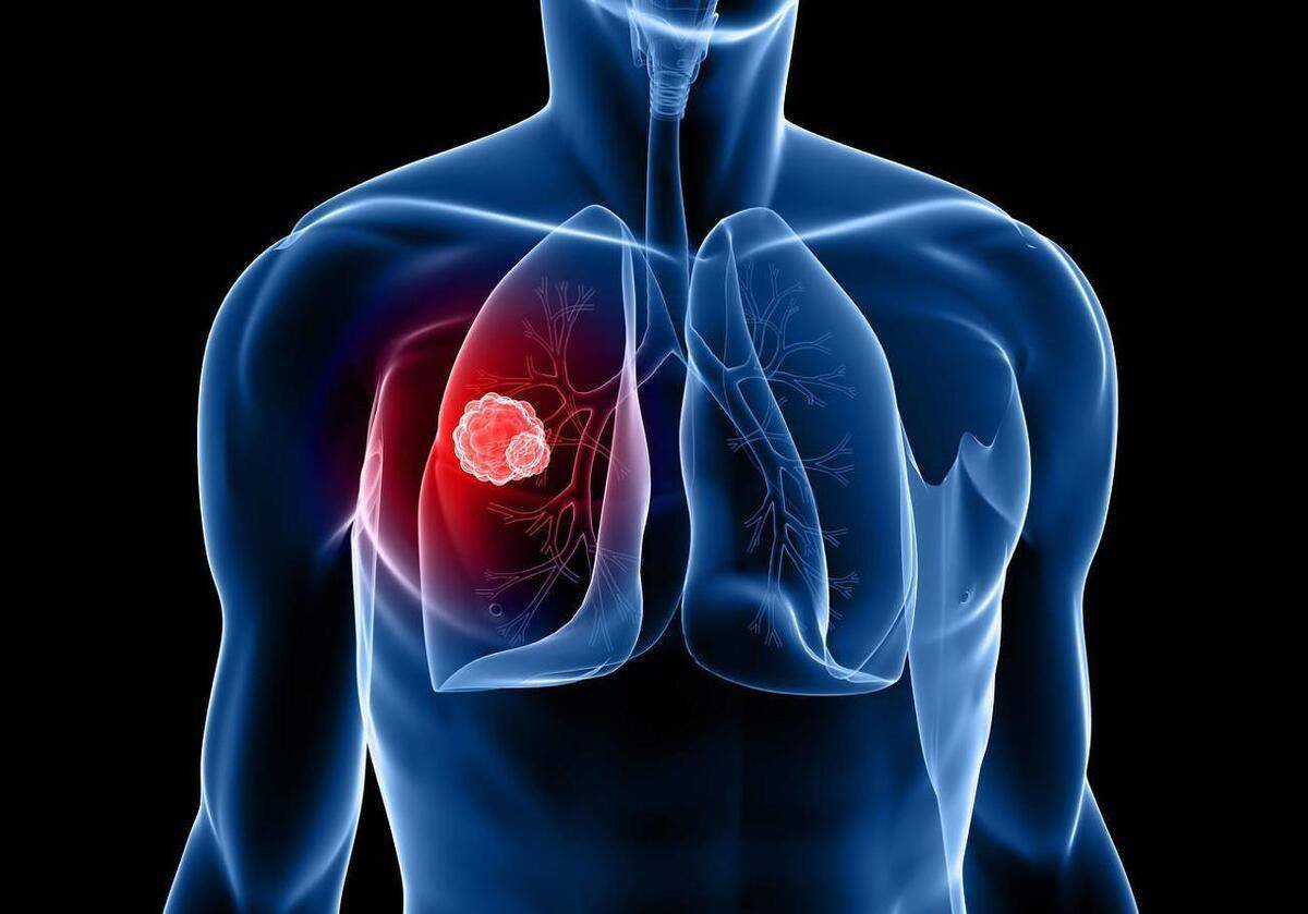 肺疼是什么原因 肺部图片