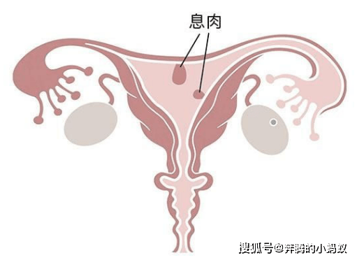 长了宫颈息肉,最好及时治疗,时间长了癌症可能会悄悄接近你!