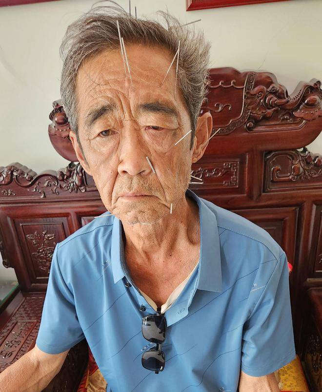 道医谢仁望提醒:嘴歪眼睛闭不全 当心是面瘫!_治疗_针灸_症状