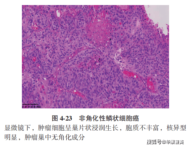 宫颈阴道镜检查后病理结果的解读_病变_上皮_粒细胞