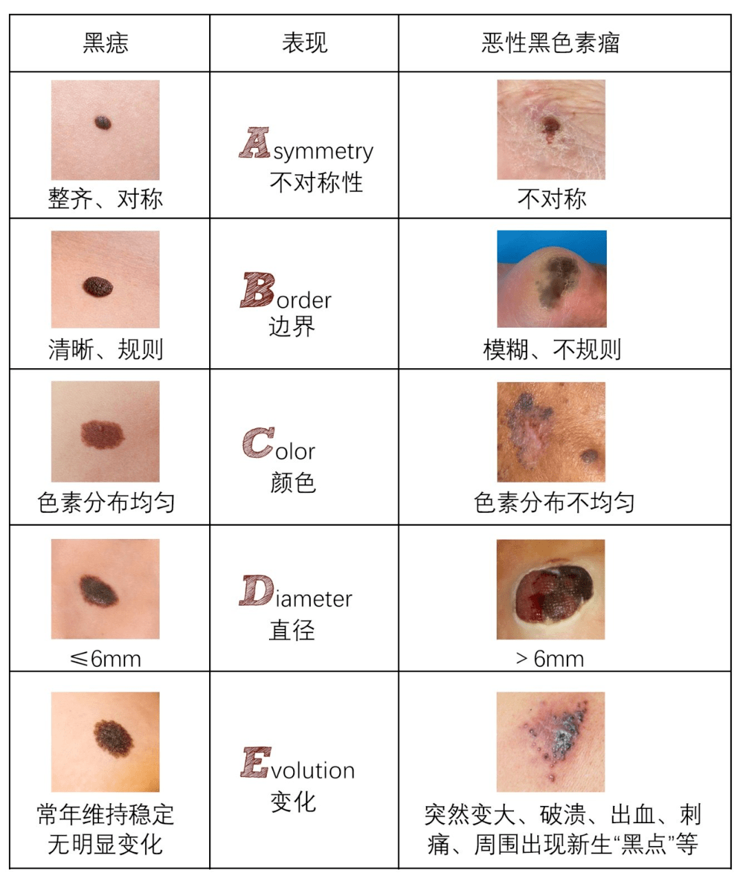 黑色素瘤登上热搜榜