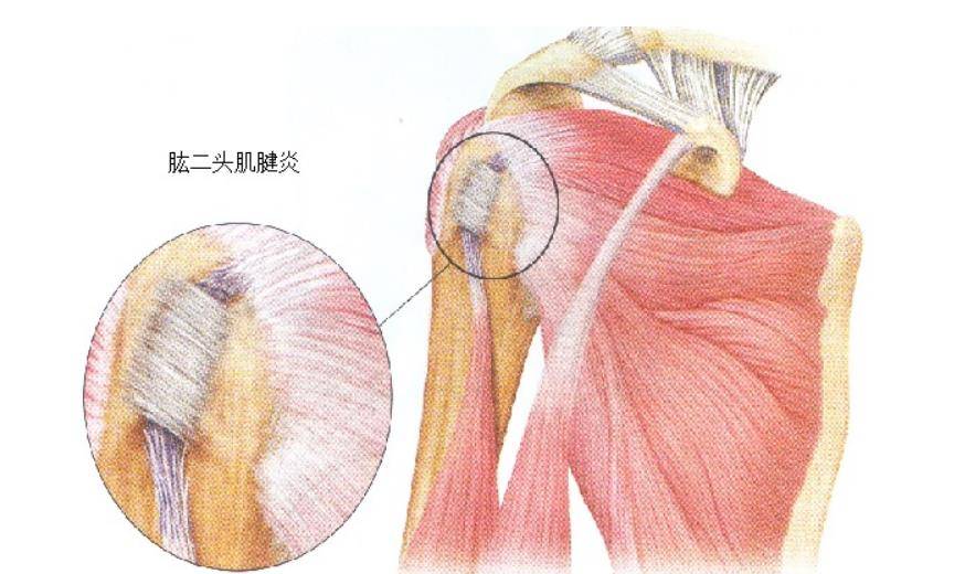 肱二头肌长头腱位置图片