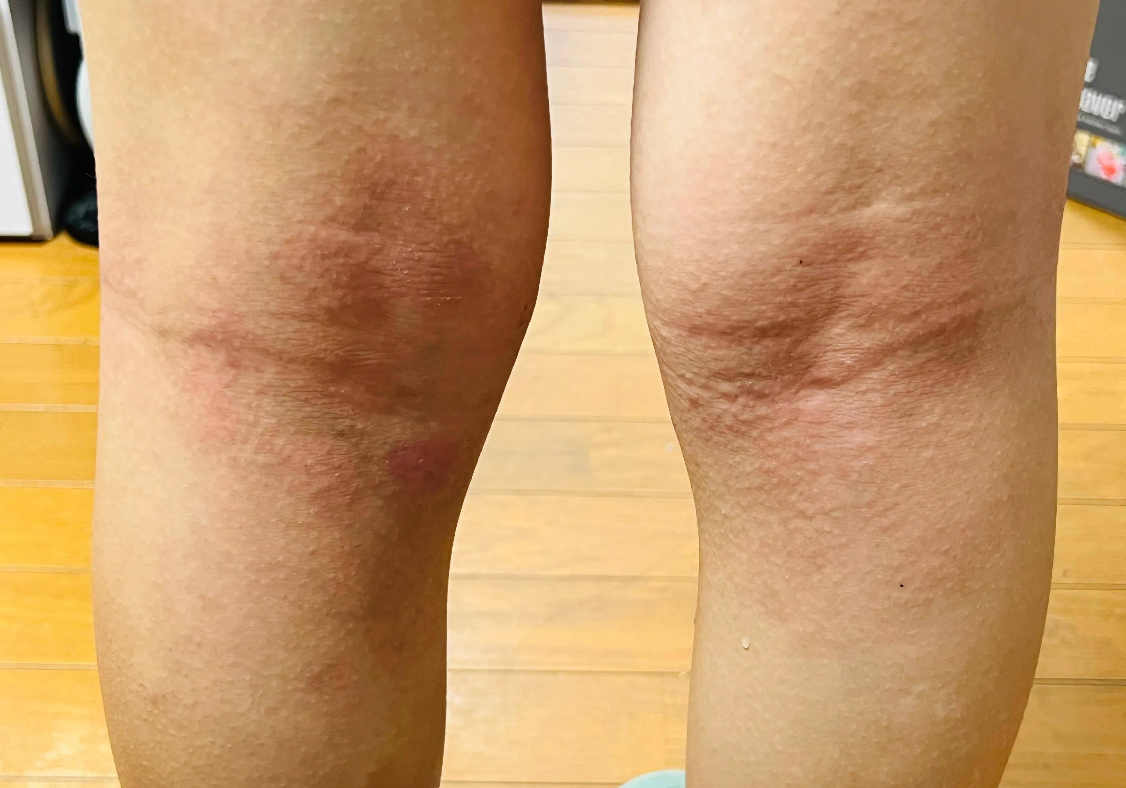 「日本生活」特异性皮炎,半个月跑一次诊所(4)