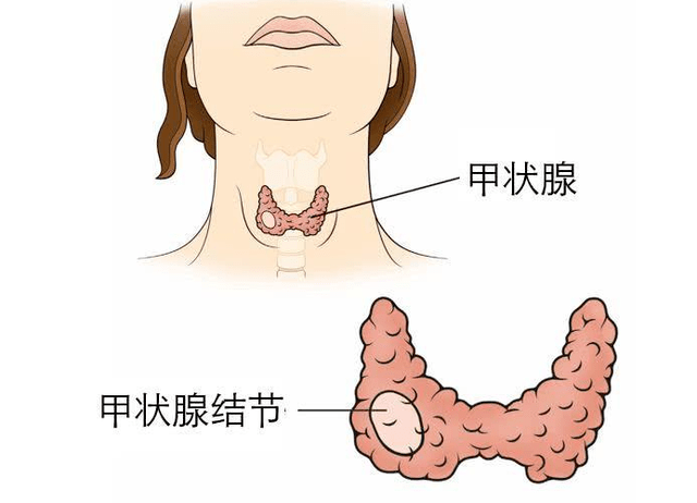 甲状腺结节4类需要手术吗？南昌贡方堂：中医治疗调理有办法！-甲状腺结节4类要手术吗