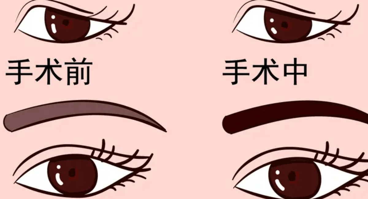 切眉手术可以保持几年?真相来喽!_进行_艾苛蜜_皮肤