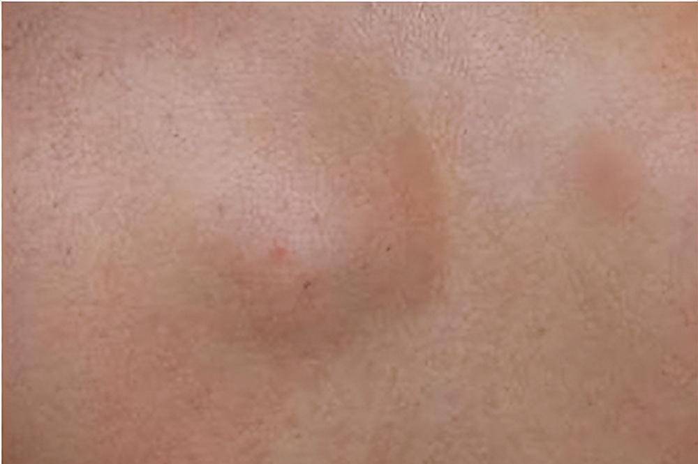 脂肪瘤是一种常见的皮下组织肿块,由脂肪细胞聚集形成