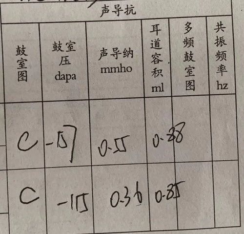 声导抗检查结果显示c型图,鼓室负压,考虑鼓室有积液.