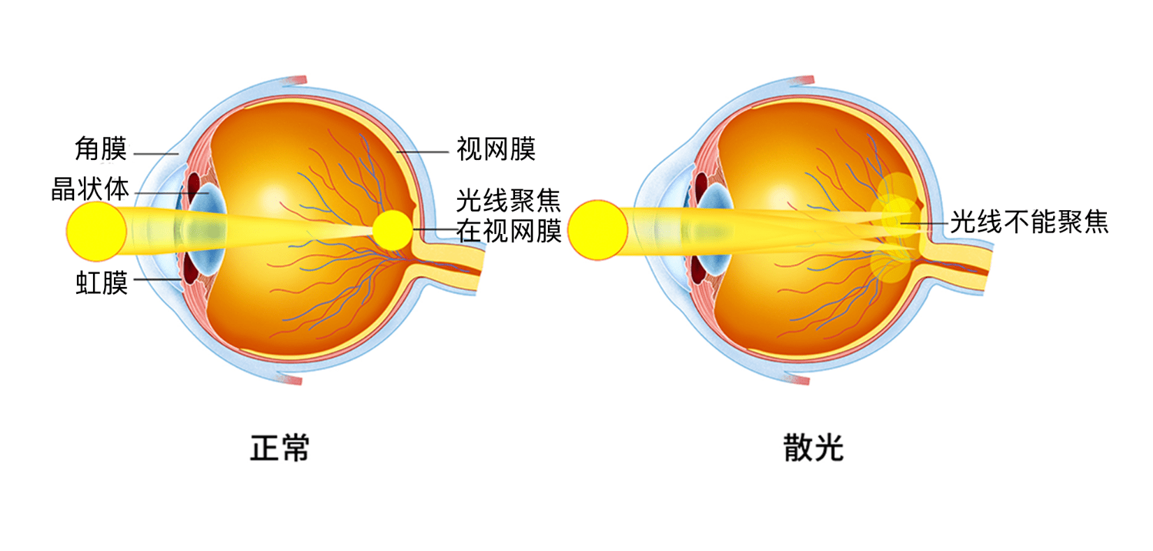 为何很多人都有散光,孩子的散光要重视吗?