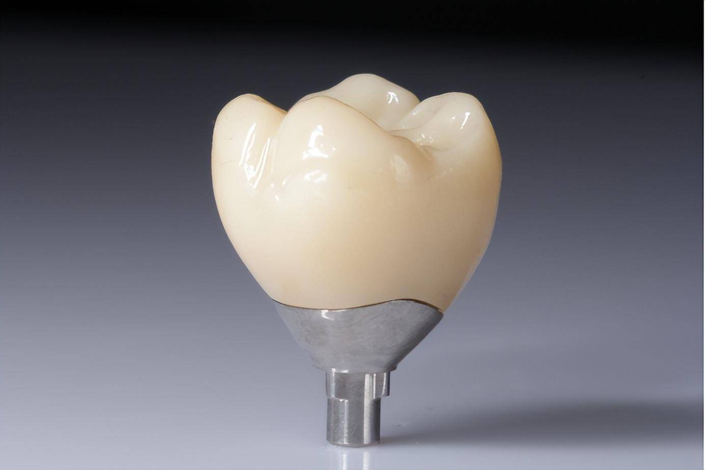 南宁数字化种植牙哪里好,区医院指定检查机构_品牌_种植体_系统