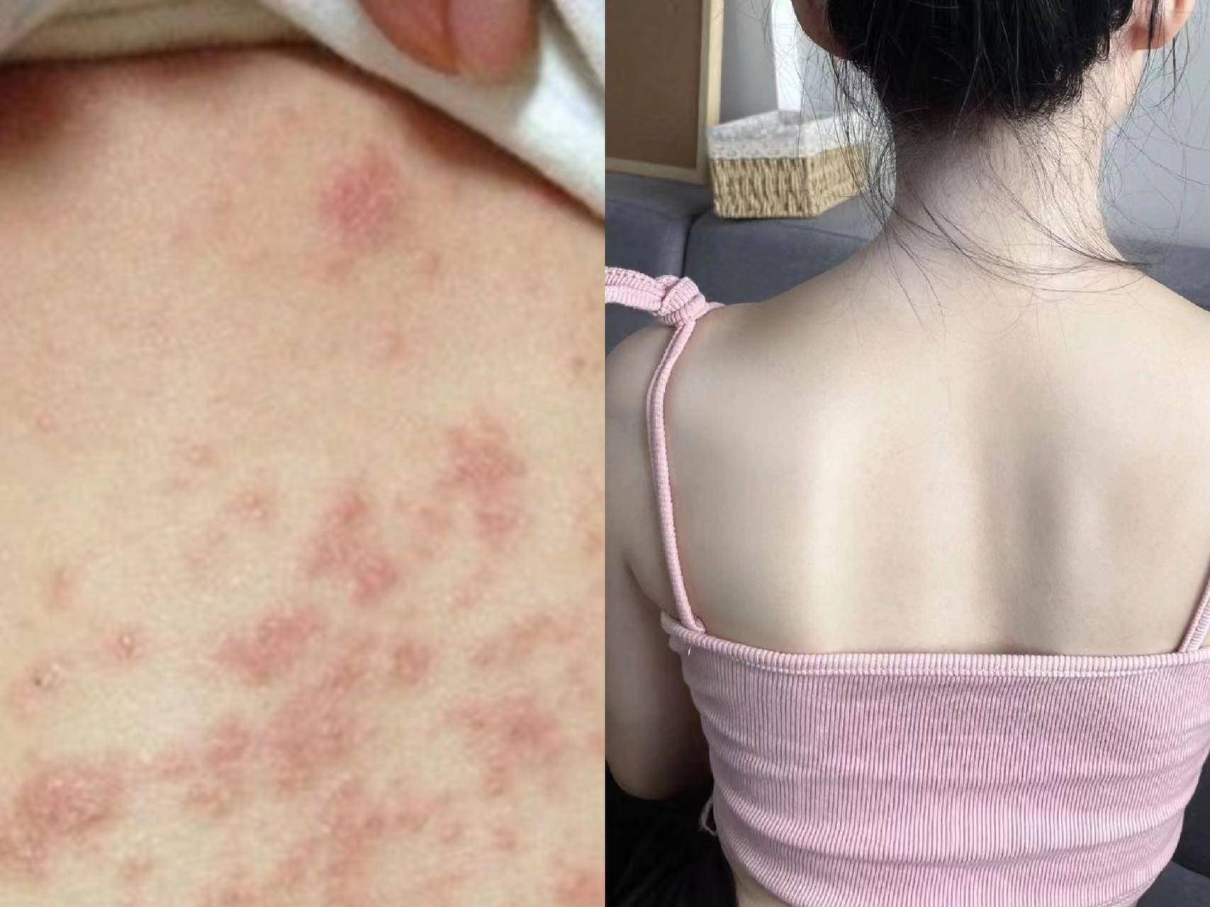 坚持运动很多人都说湿疹是因为免疫力低加上过敏,所以我每天都运动
