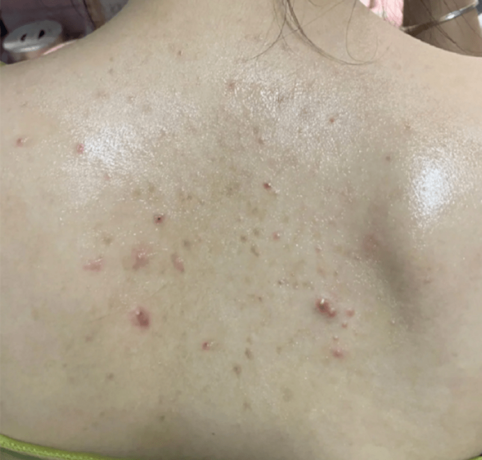1,注意清洁当发现背部长出痘痘后,一定要经常洗澡,这也是最为直接有效
