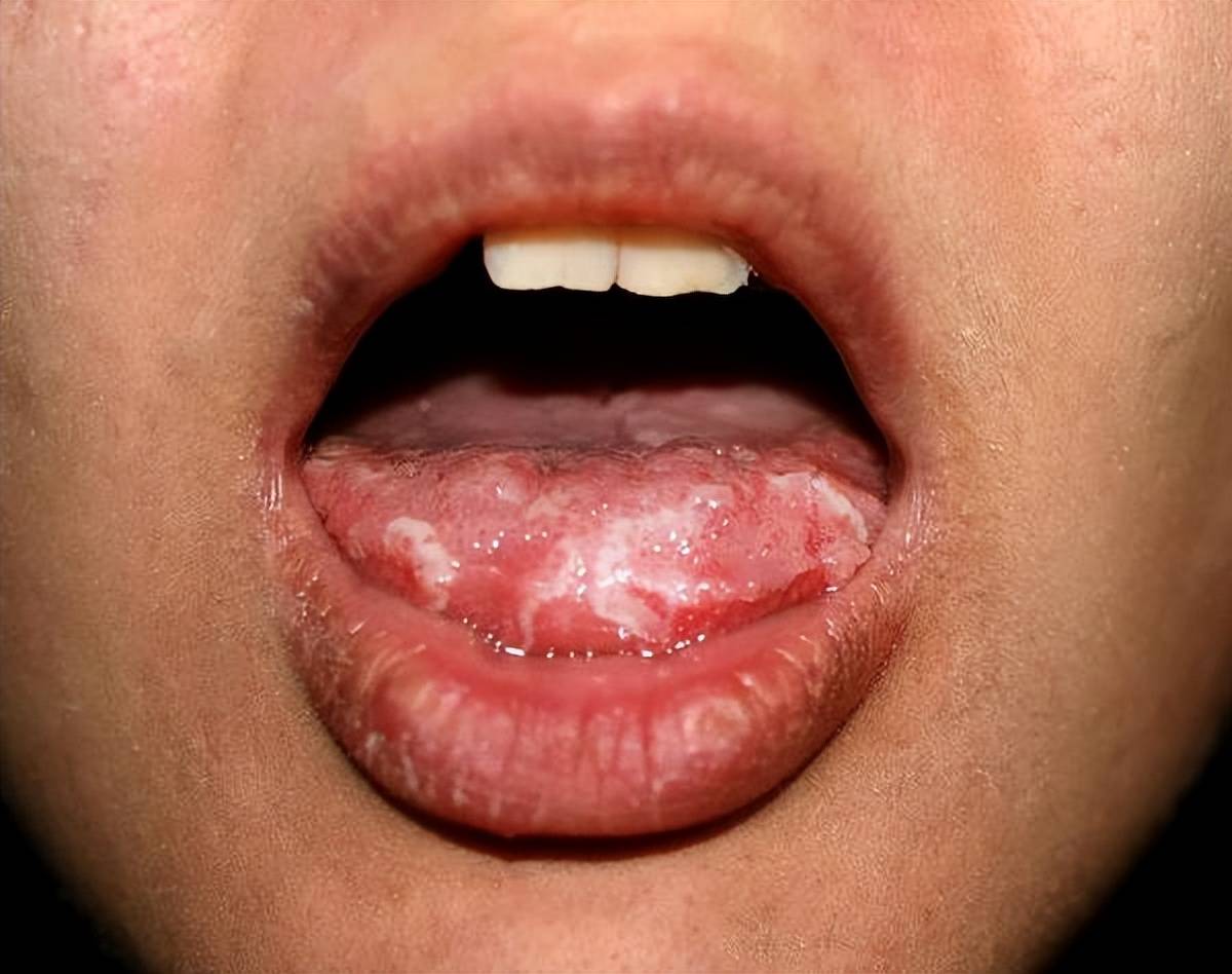 口腔溃疡与口腔癌怎么鉴别(附从这6个部位入手)