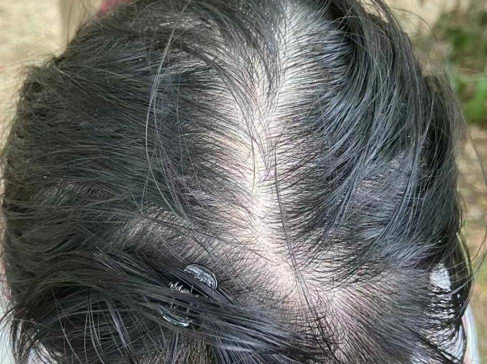 过来人免费分享生发秘籍!坚持60天逆袭浓密黑发!_头发_方法_食物