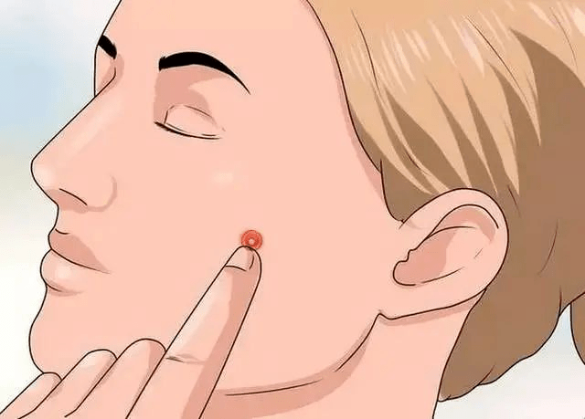 广东民安医院靠谱讲解肛周有脓包不要乱挤,当心诱发