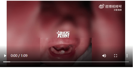 早产儿出生罕见长2颗牙先后被拔掉，医生：怕宝宝呛到气管