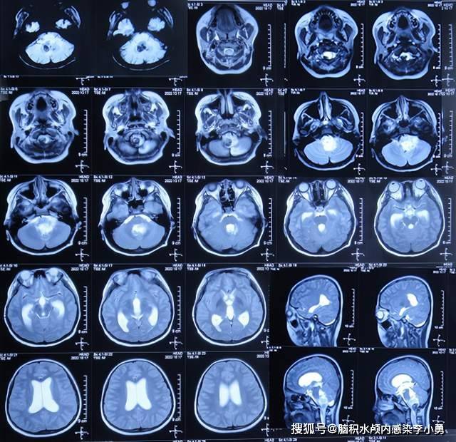 10岁患儿脑干星形细胞瘤瘤内出血致早期脑积水头痛呕吐嗜睡