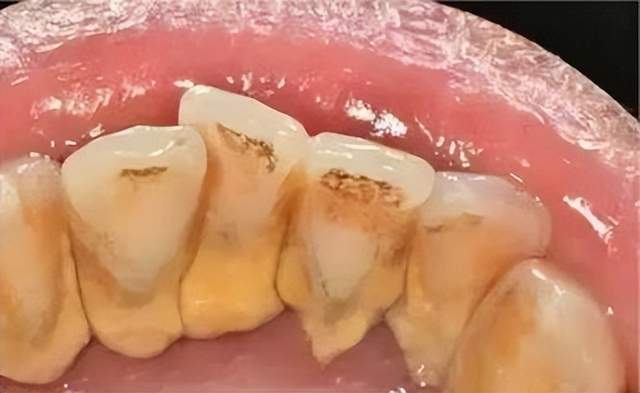 牙结石厚到用手抠?过来人传授你三大秘诀,学会后终身受益!