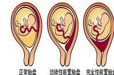 胎盘前壁和胎盘前置,一字之差,差之千里,孕妈妈千万别弄混了