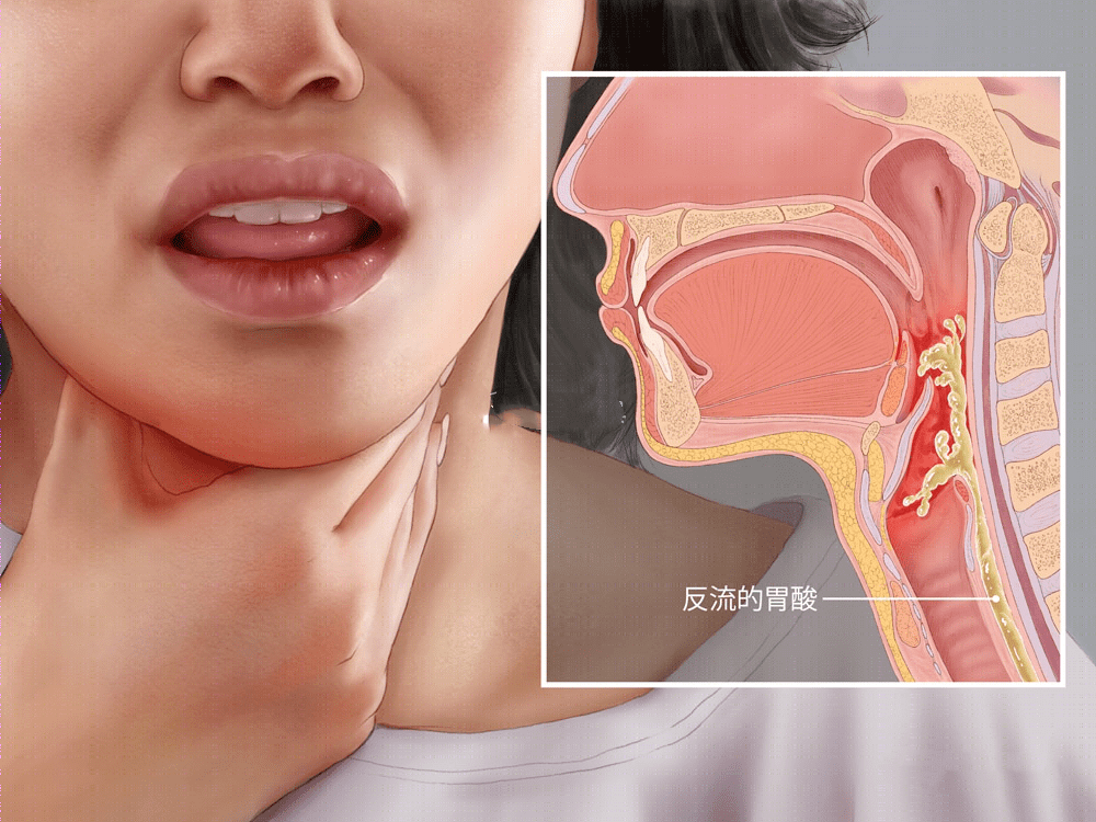 你是不是经常遇到咽不下去又吐不出来的感觉,这都是反流性咽炎惹的祸!