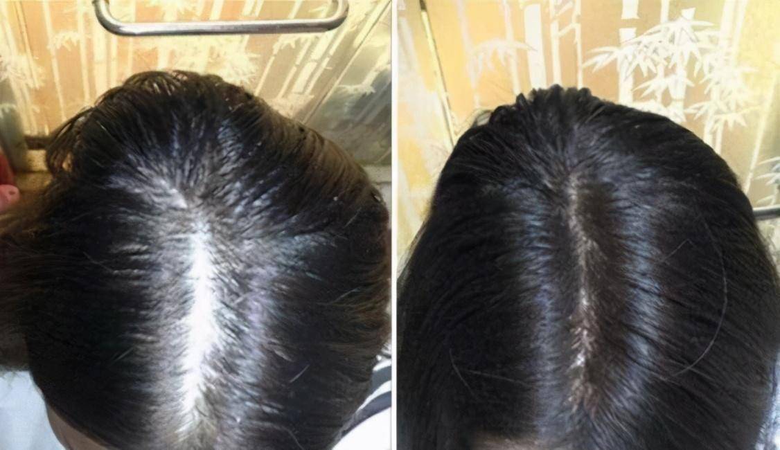 宋仲基发量稀少颜值大跌,现身好友婚礼现场,让人差点认不出_头发_头皮