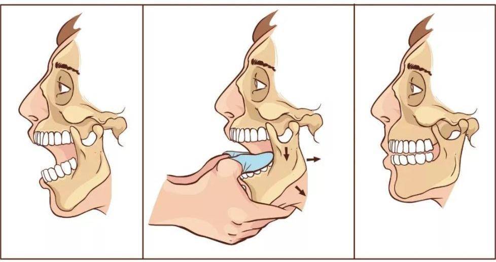 我不允许你还不知道,下巴脱臼的复位手法