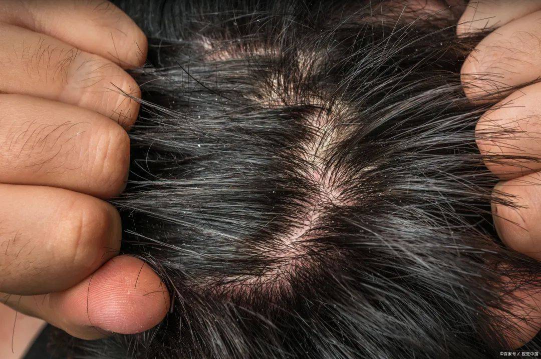 头皮问题:头皮状况不佳,如头皮屑,油脂分泌异常或头皮感染,可能会影响