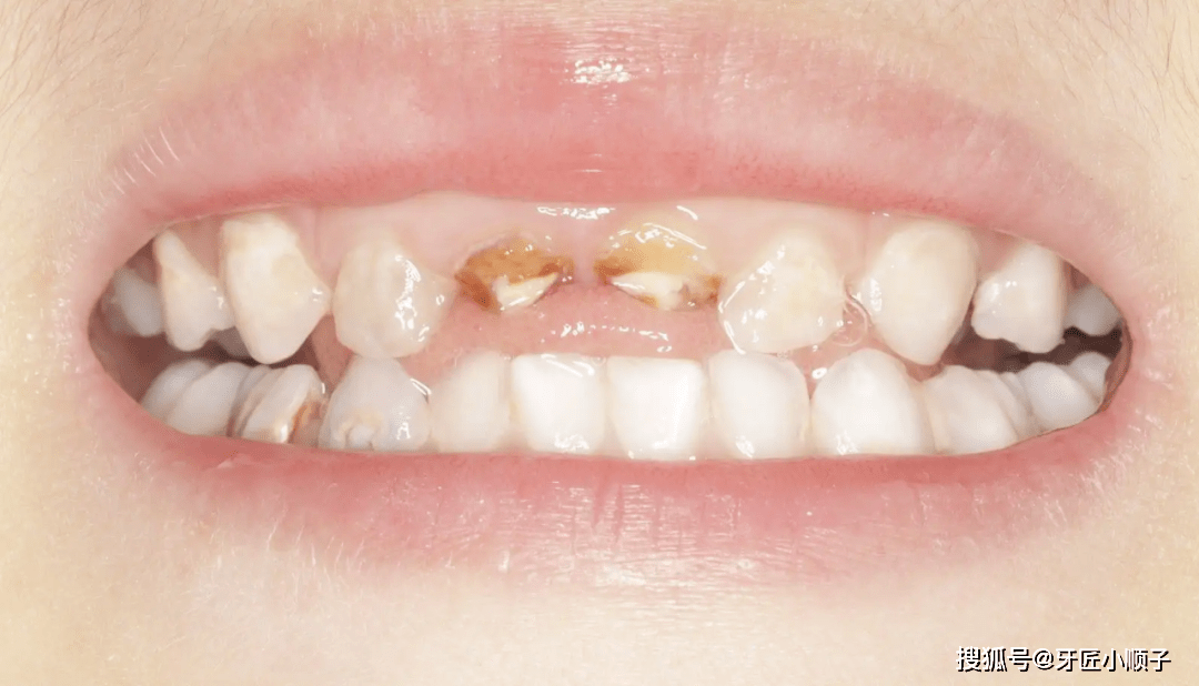 【本周看点】乳牙龋坏,是否需要去口腔医院进行根管治疗?
