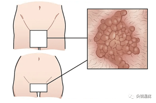 外阴长颗粒图片