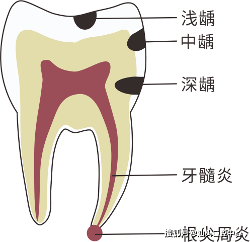 乳牙牙髓炎必须根管治疗吗?根管治疗是否会影响换牙?