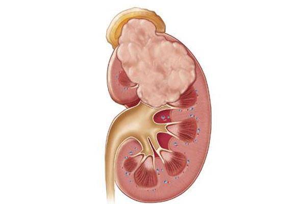 【和谐解读】广州和谐医院邵汛帆教授:肾癌到底该怎么治疗?