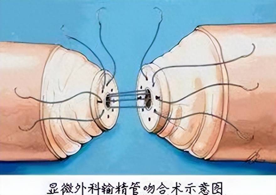 北大医院太原医院生殖中心成功开展显微镜下输精管吻合术
