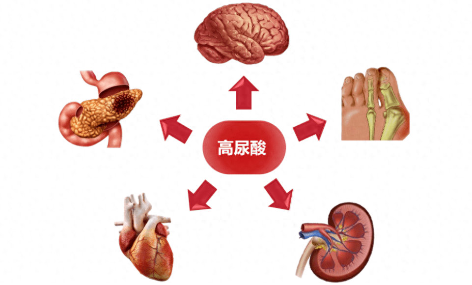 尿酸高是怎么导致的原因？高尿酸血症是什么病？培养7种健康习惯