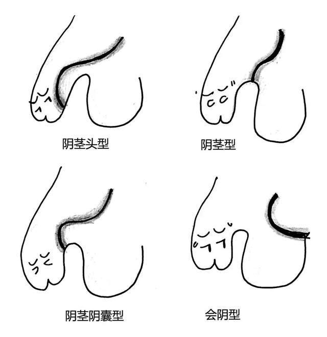 尿道下裂分型的图片图片