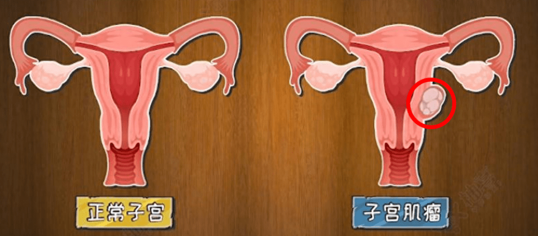 50岁女子10年养出109颗子宫肌瘤,什么样的子宫肌瘤会恶变？