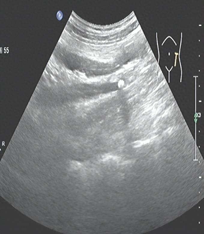 输尿管结石b超图图片