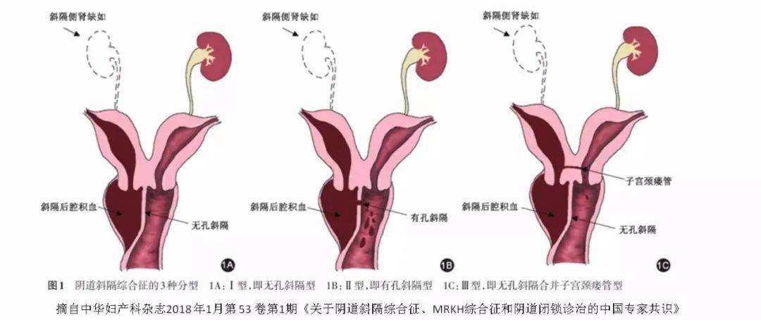 宫颈闭锁图片图片