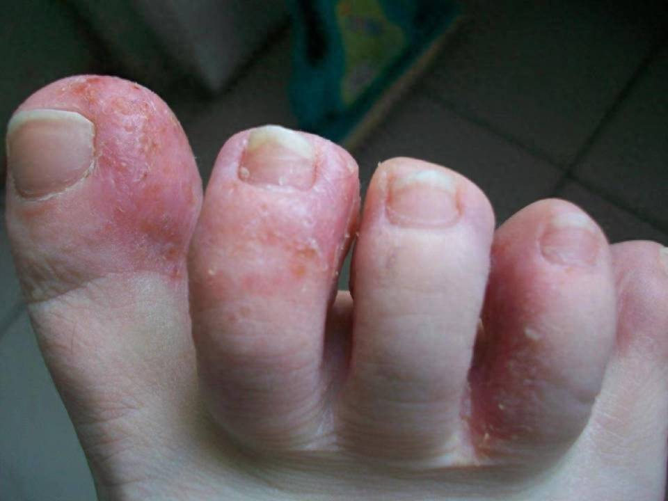 脚部就会滋生很多细菌,这些细菌长期堆积就会形成脚气!