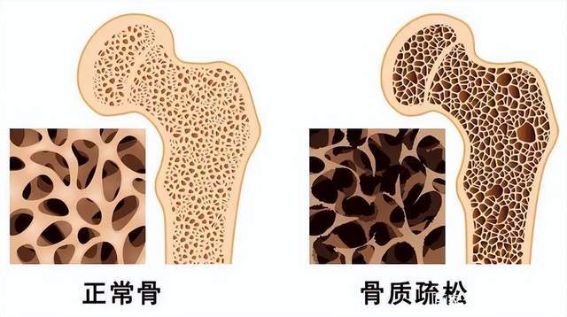骨质疏松症是由于多种原因导致的骨密度及骨质量下降,骨微结构破坏