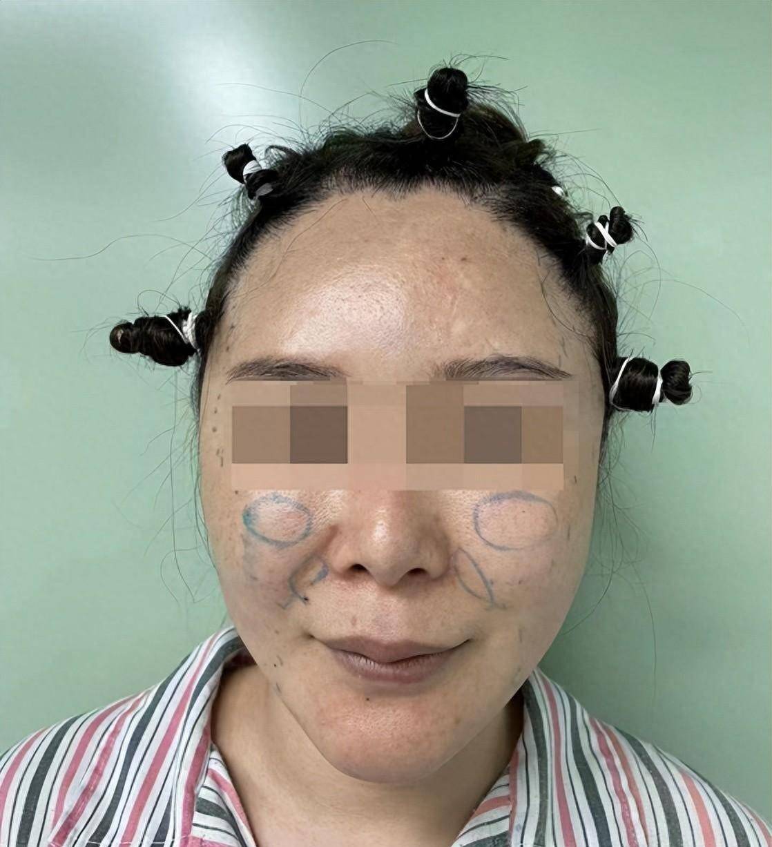 注射数百玻尿酸寻求整容手术修复_袁博_效果_医生