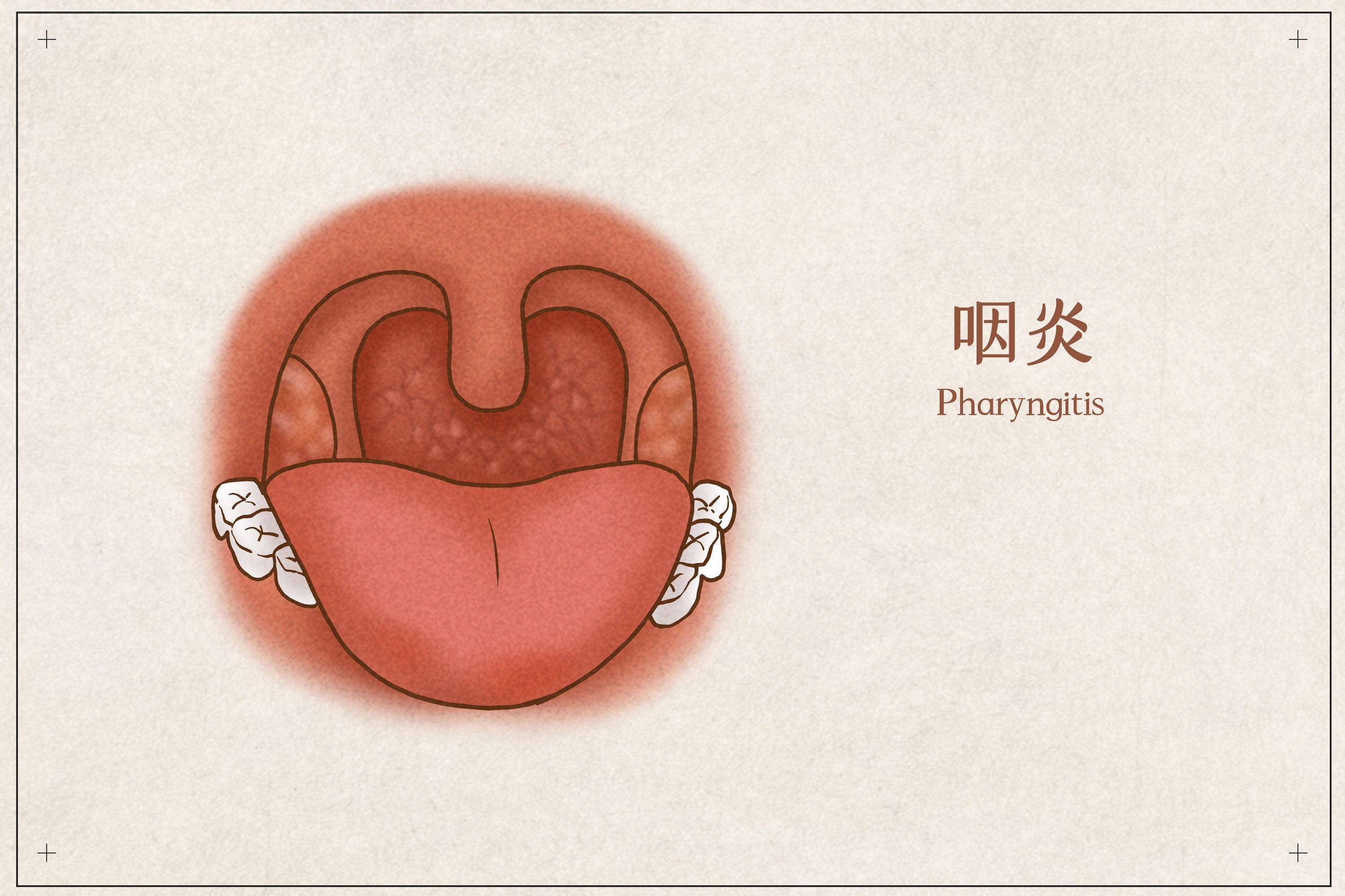 医生提醒:做好8点预防,守护咽喉健康无忧