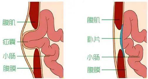 腹股沟疝的手术治疗及术后护理