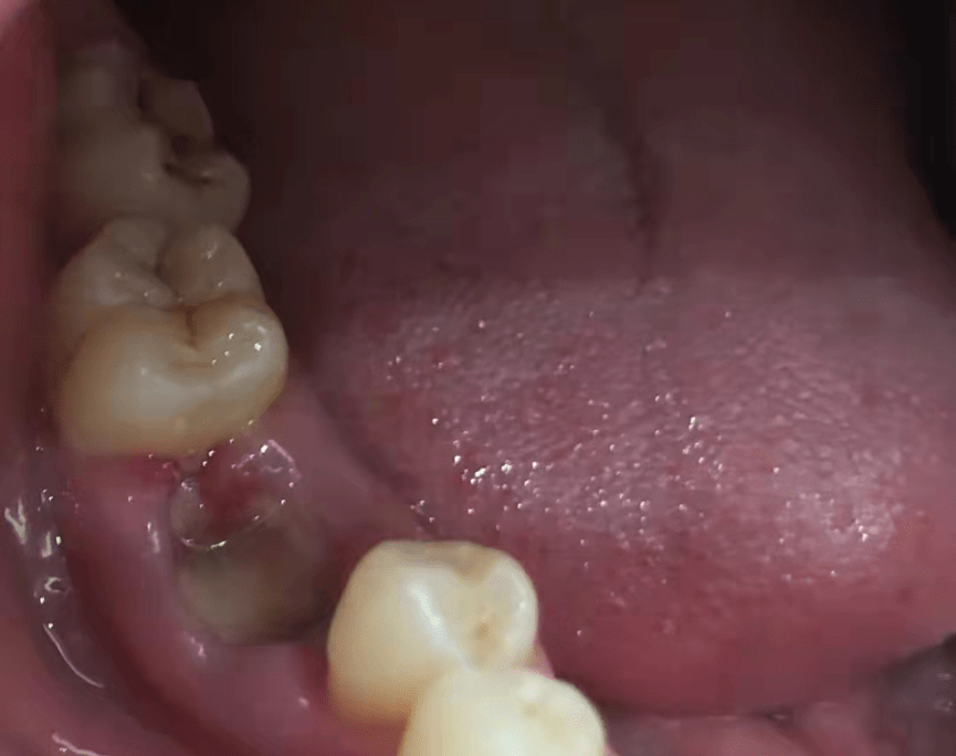 拔牙人士须知:戒备19大口腔护理风险黑幕!