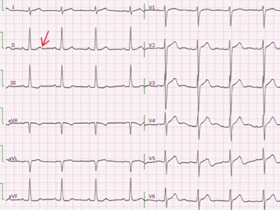窦性心律2ii,iii,avf导联st