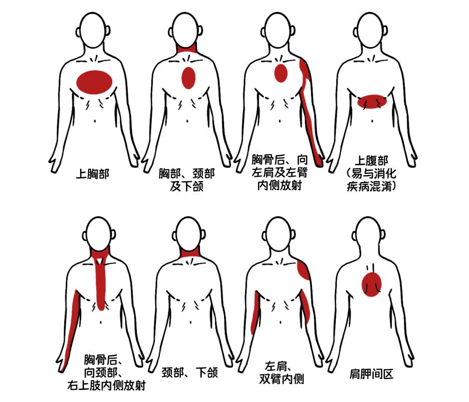 如果在心绞痛发作时心电图上有心肌缺血的表现