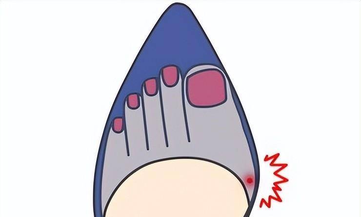 你知道?_脚趾_挤压_脚骨